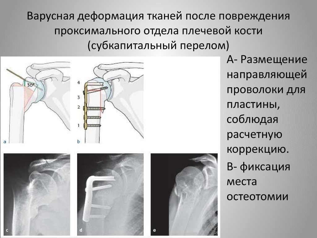 Варусное деформация костей