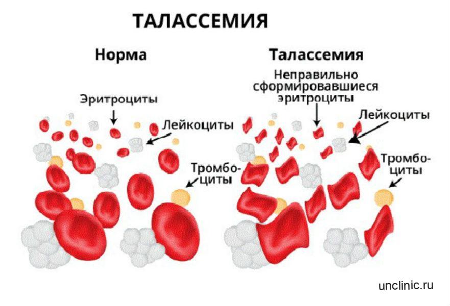 Талассемия клиническая картина