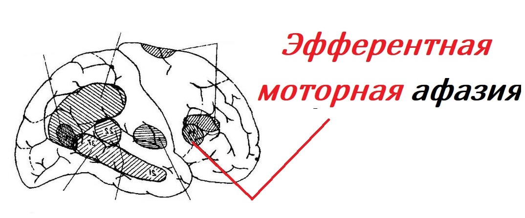 Эфферентная моторная афазия презентация