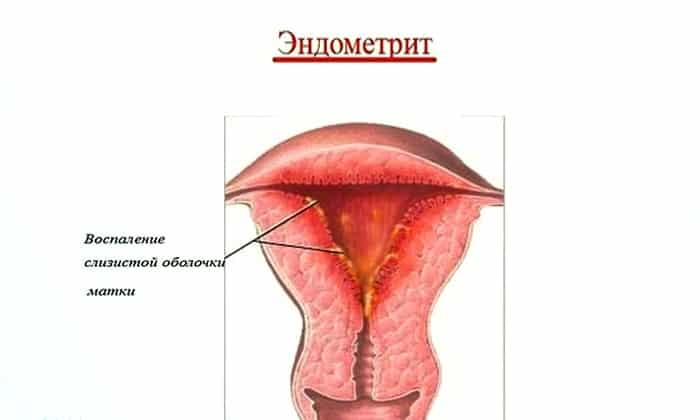 Воспаление матки отзывы. Послеродовый эндометрит. Слизистое воспаление оболочки матки. Слизистая хронический эндометрит. Хронический эндометрит матки.