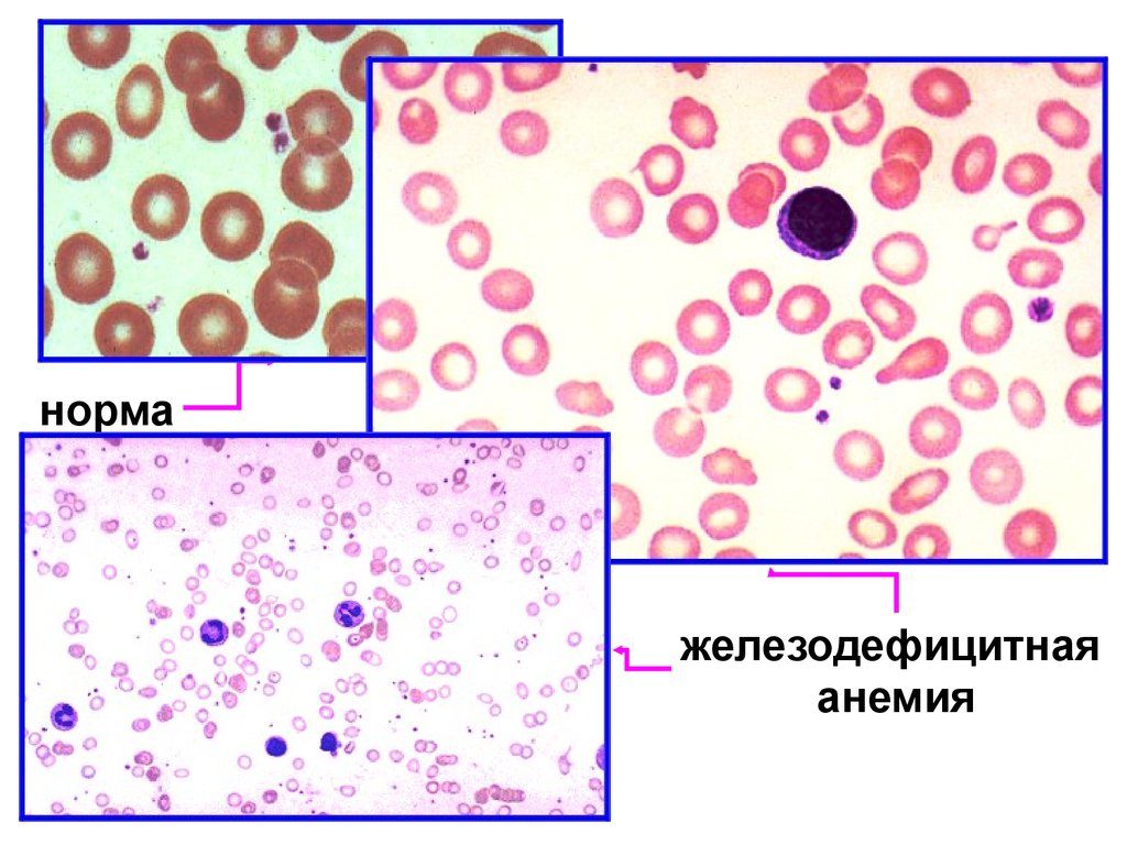 Изменение клеток крови. Картина мазка крови при железодефицитной анемии. Микроскопия эритроцитов при железодефицитной анемии. Пойкилоцитоз анемия. Железодефицитная анемия анизоцитоз пойкилоцитоз.